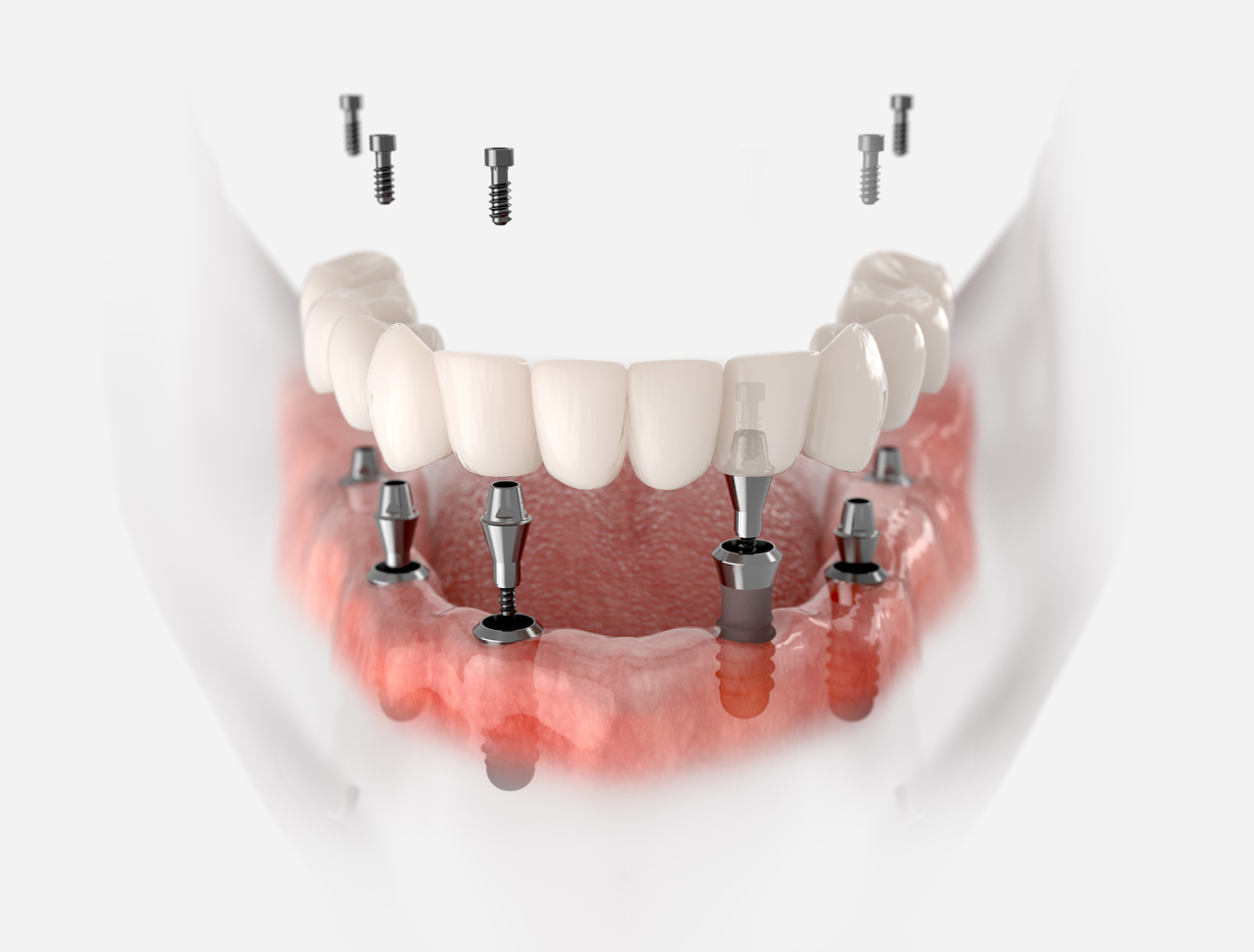 Mandibular prosthesis