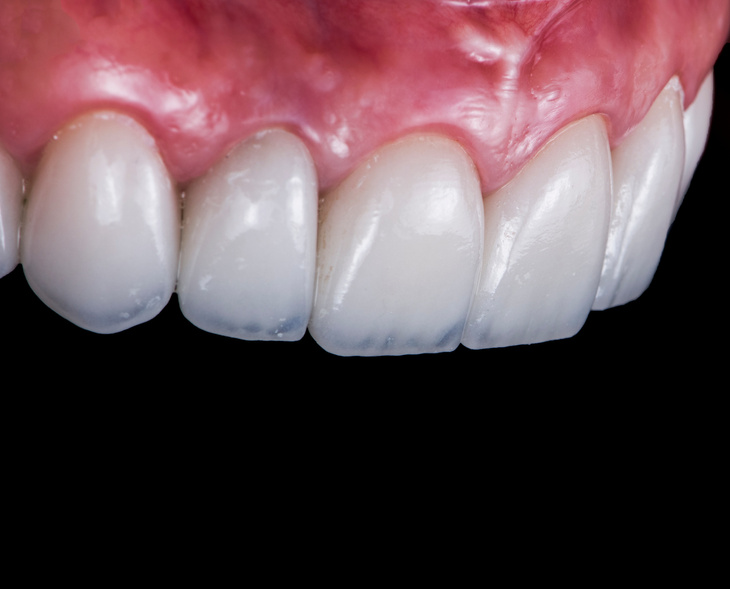 press ceramic veneers b2 color